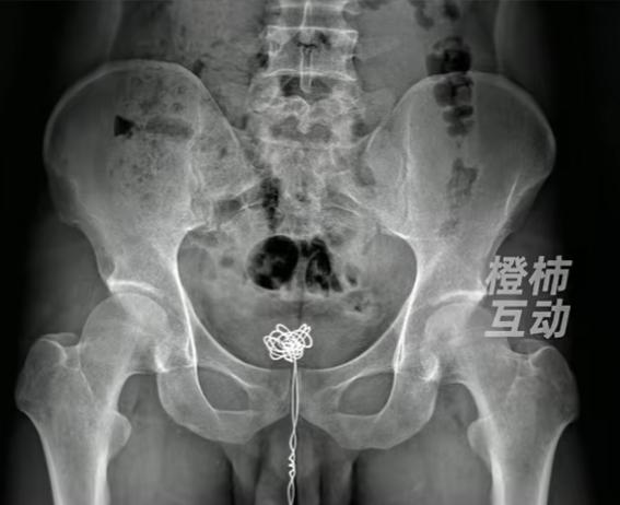 “丢人丢大了！”6月23日报道，广东深圳，一男子因为好奇，盲目尝试危险猎奇行为，