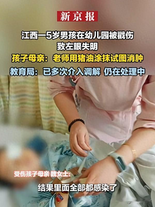 江西5岁童幼儿园遭戳伤失明，老师竟涂猪油处理！后续治疗费成难题
 
10月9日，