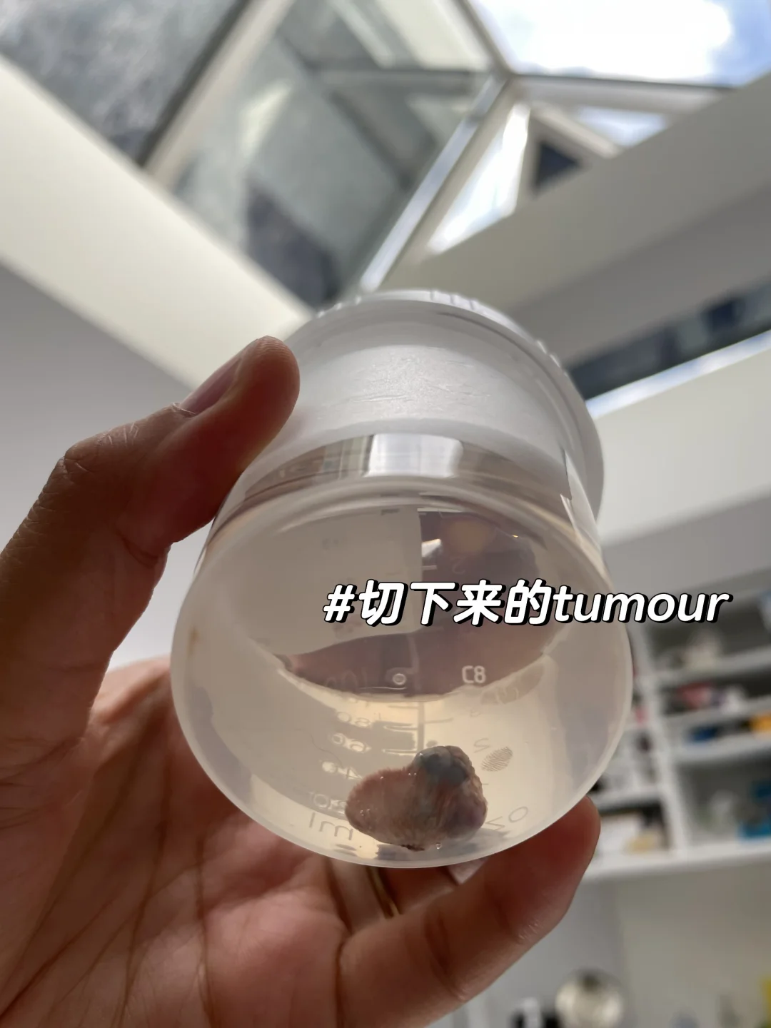 绵绵手术顺利 手术成功