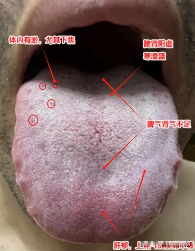 遇到这种舌象，千万不要光顾着疏肝健脾补肾阳，否则会耽误大事的。

患者主诉：充电