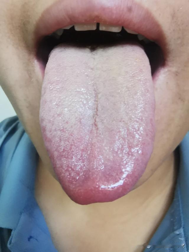 门诊37岁大哥，最近有点 “不太行了” 来看看能不能弄点药补补
仔细一看舌头，好