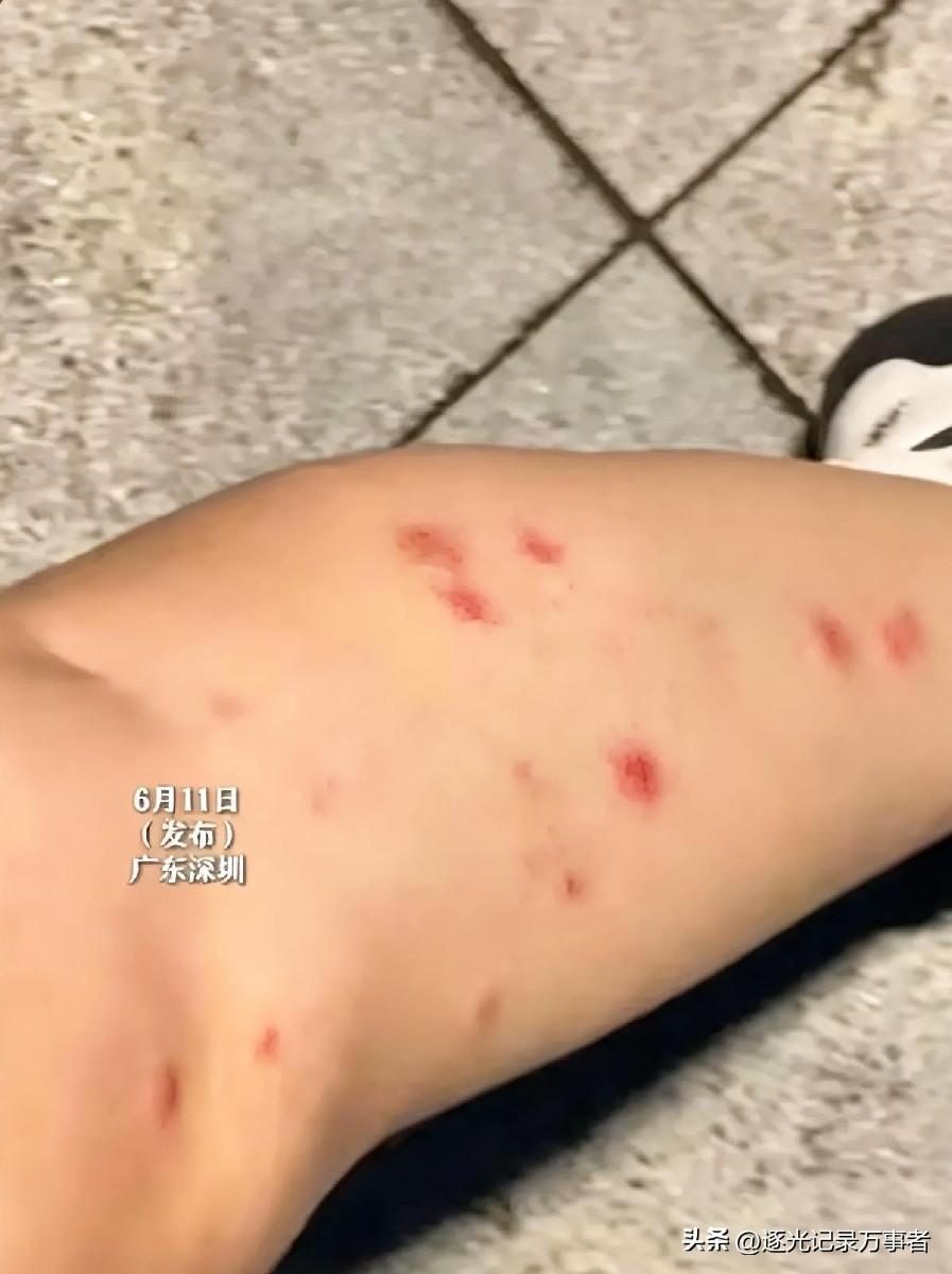 深圳女子小曹夜跑时,被蚊子叮咬出30个大包，她通过当地政务小程序的“蚊虫随手拍”