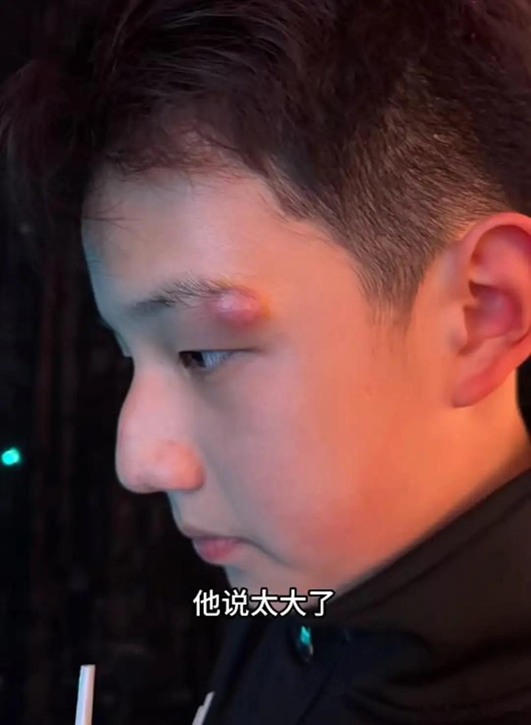 关凌13岁儿子眉尾长火疖子，用针挑破后变严重，到医院手术缝4针！ 