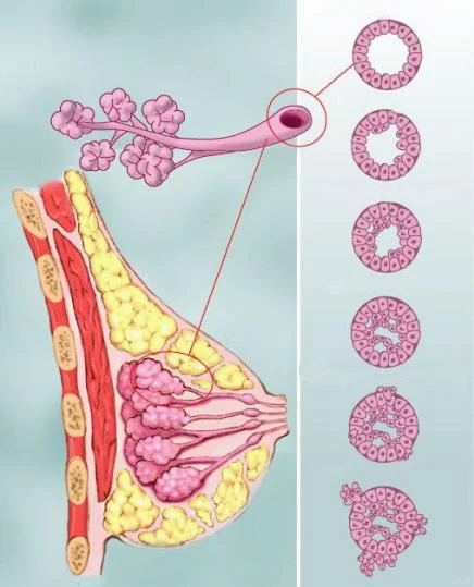 乳腺不典型增生虽不是肿瘤，尚需引起重视⚠️