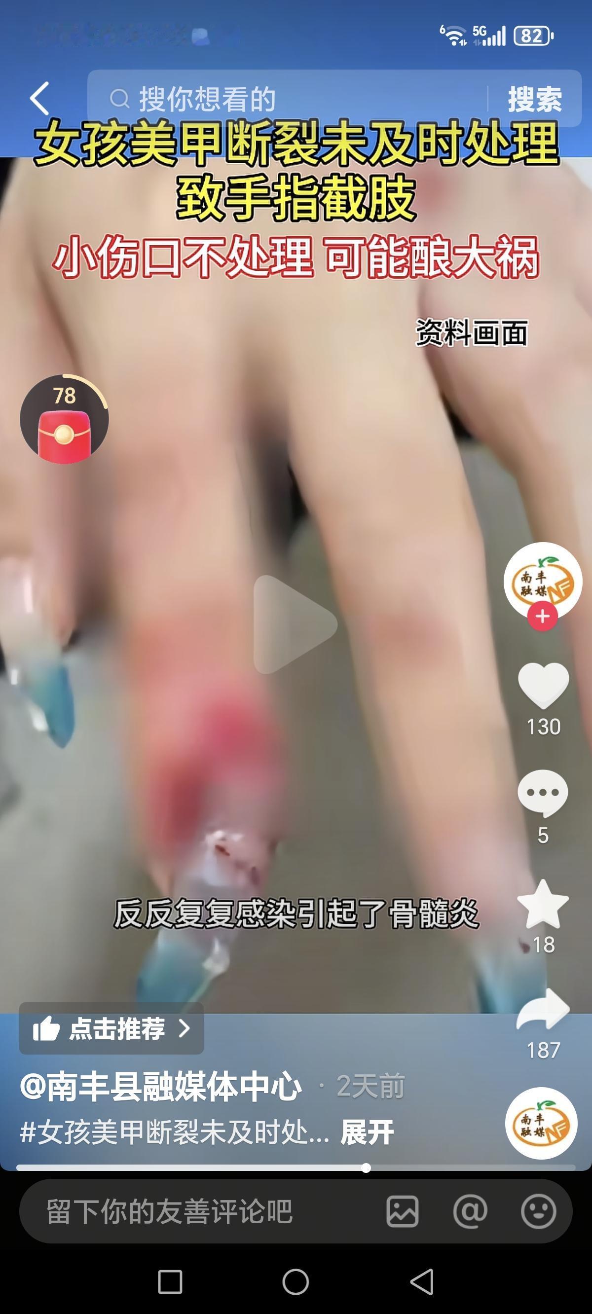 悲剧还是发生了！近日，浙江杭州一女子为了爱美，给自己做了一套长长的美甲，还没开心