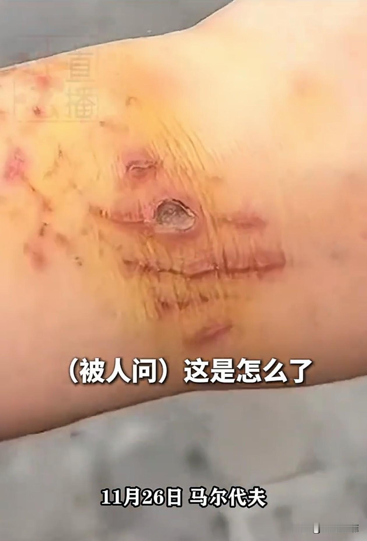 上海，一女子去马来西亚旅游，生理期来了却还坚持潜水，结果被鲨鱼咬了，朋友都好心告