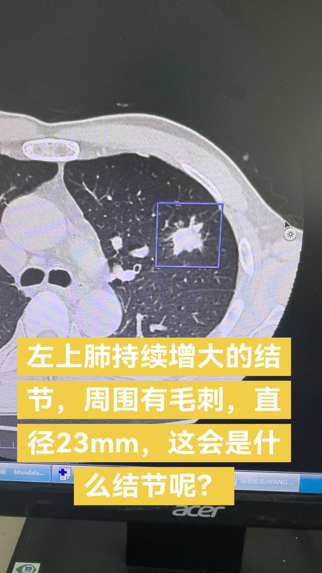 左上肺持续增大的结节，周围有毛刺，直径23mm，这会是什么结节呢？