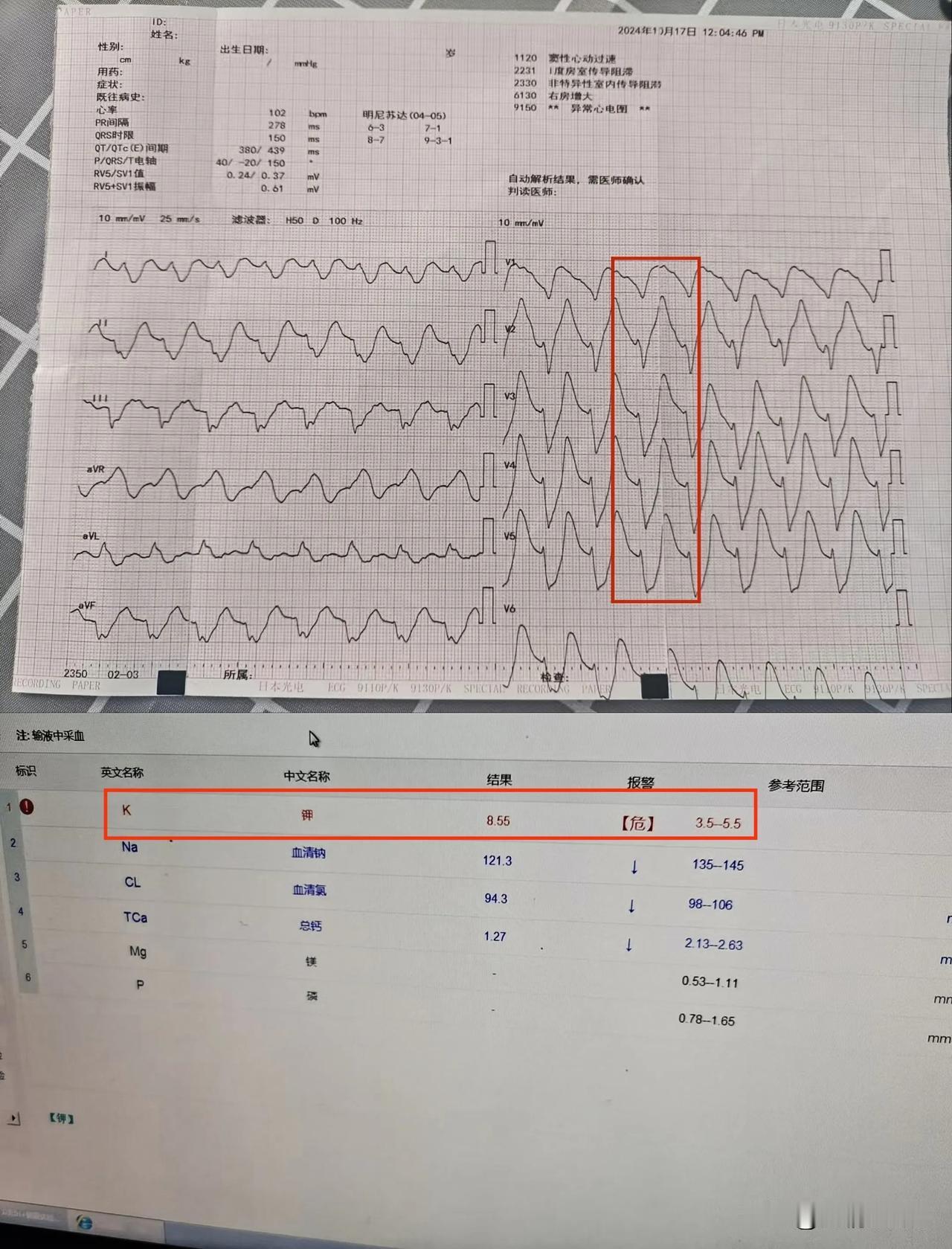 典型高钾血症心电图
窦室传导
T波底窄高尖锐利
血钾8.55mmol/L（见下图