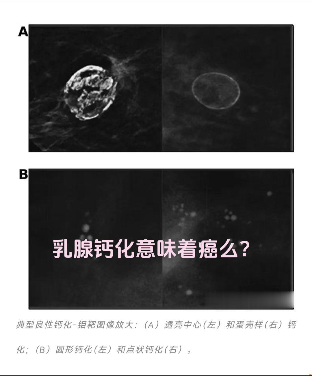 乳腺钙化不一定是癌。1、乳腺内钙化极为常见，可以出现在80%的乳房钼靶...