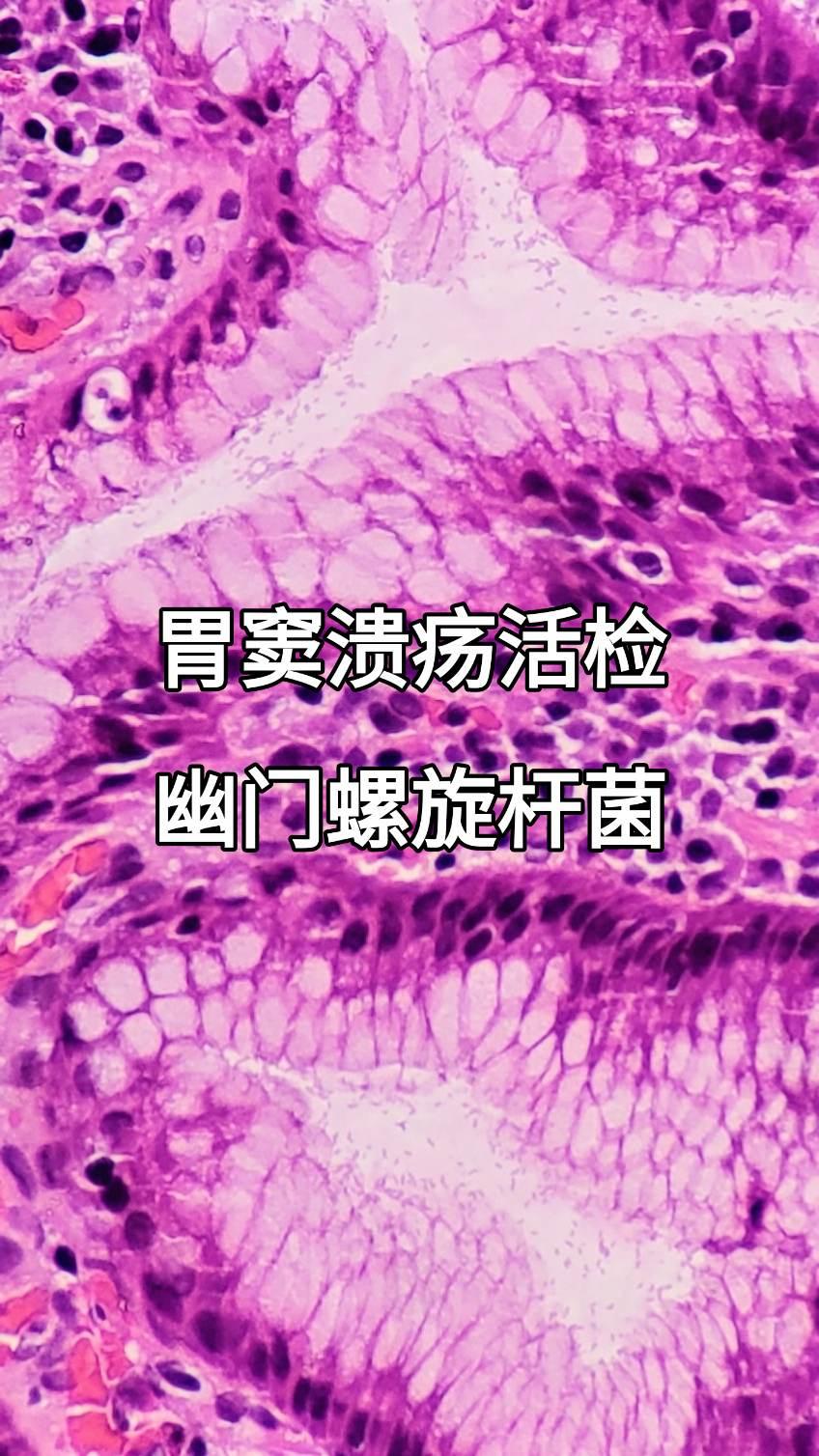 胃窦溃疡 幽门螺杆菌