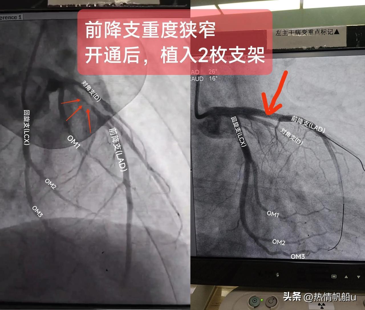 急性非ST段抬高型心肌梗死
(前降支重度狭窄)
一.概念：
前降支主要为前壁及前