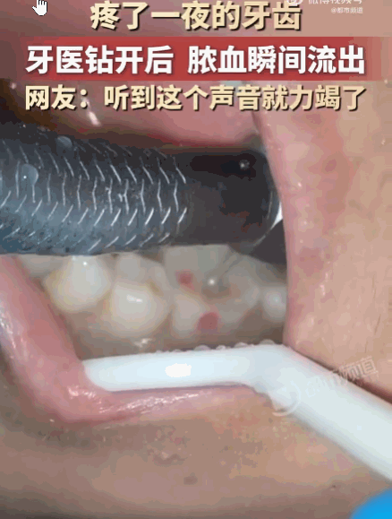 看着都疼！河南，一男子深夜突发剧烈牙痛，整整一夜被折磨得死去活来，崩溃至极。次日