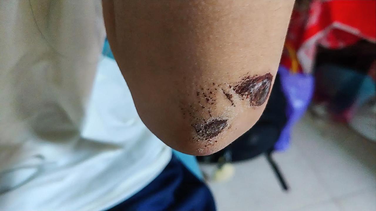 摔这一跤，疼的是胳膊，醒的是脑子！
 
谁他妈没摔过这种实打实的硬跤？看这胳膊上