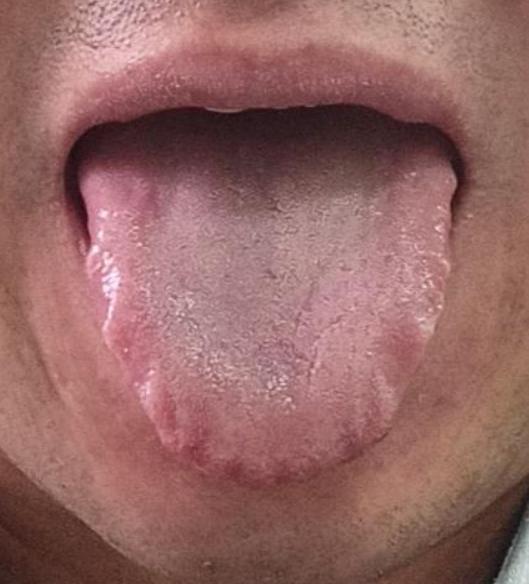 舌边鼓胀 + 齿痕，别瞎清热！越清越虚，男科问题还会找上门
大家好，我是中医陈大