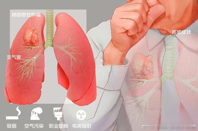 【燥热伤肺是肺癌干咳和燥证的重要病机】健康科普中医养生说肺癌是临床常见的恶性肿瘤