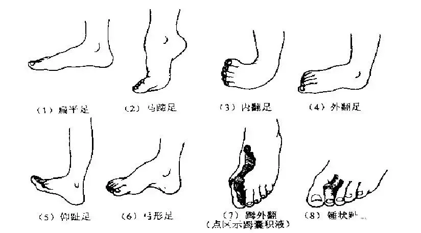 常见足部畸形