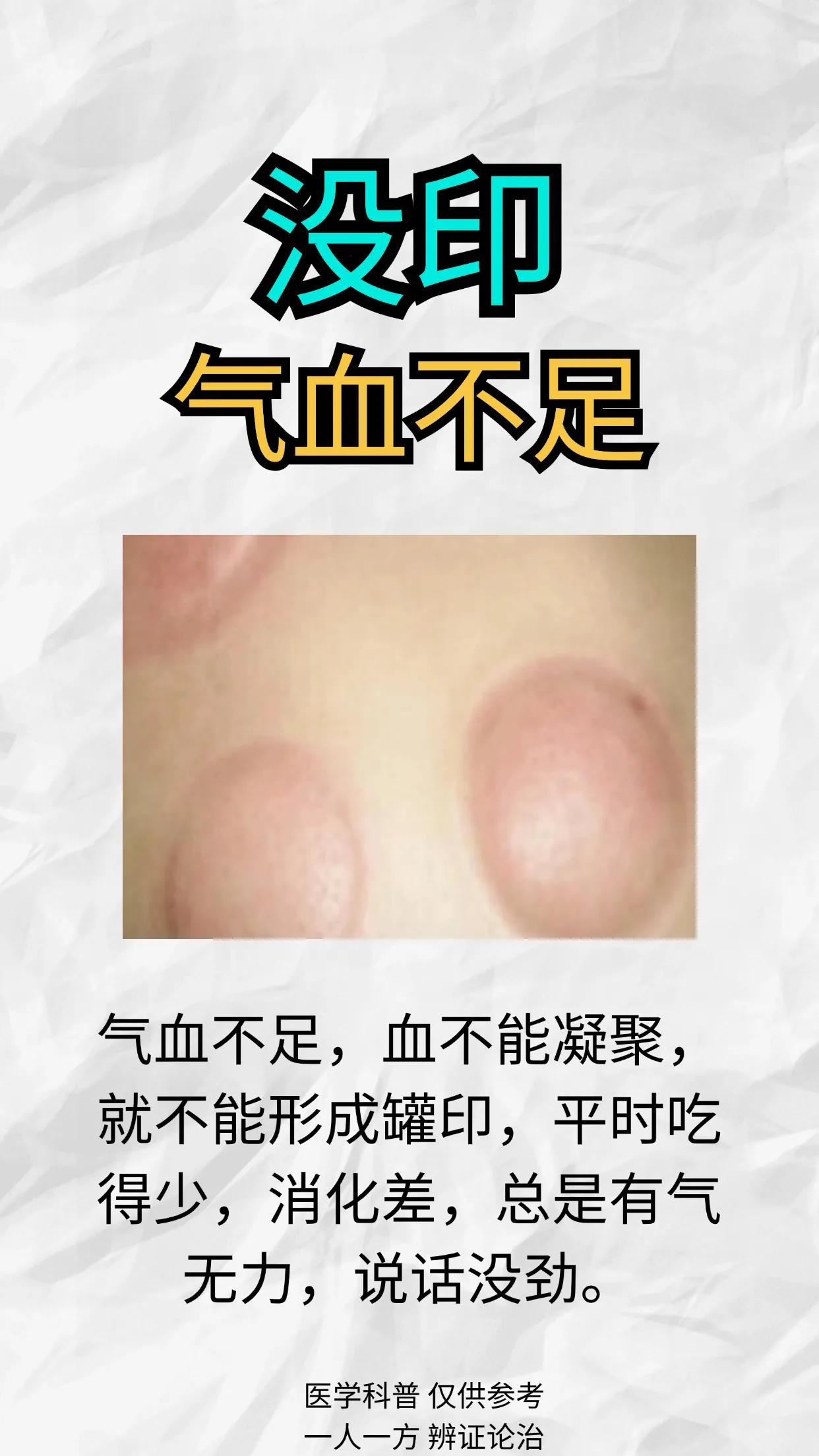 经常拔罐的朋友，你真的知道自己到底是什么体质吗？

#中医# #健康科普# #健