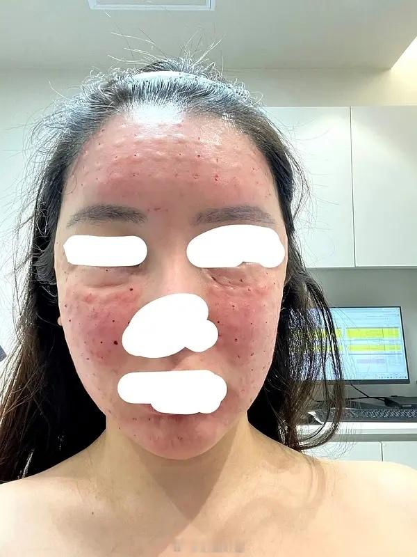 金子涵应该是打的这个针吧？看到的科普打的丽/珠/兰，打的针数多 而且搜了一下看都