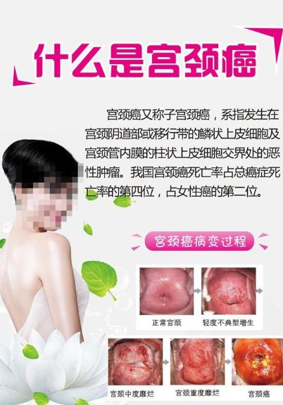 曾经宫颈检查正常 现在为何确诊宫颈癌晚期 一次检查宫颈正常就代表永远不会确诊宫颈