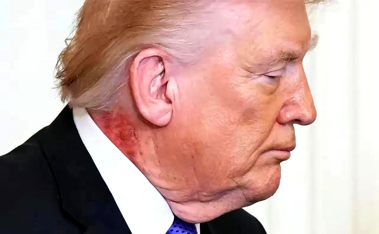 一个前总统的健康，从来不是医学问题，而是政治精算学。
手背上的淤青，脖颈处的红