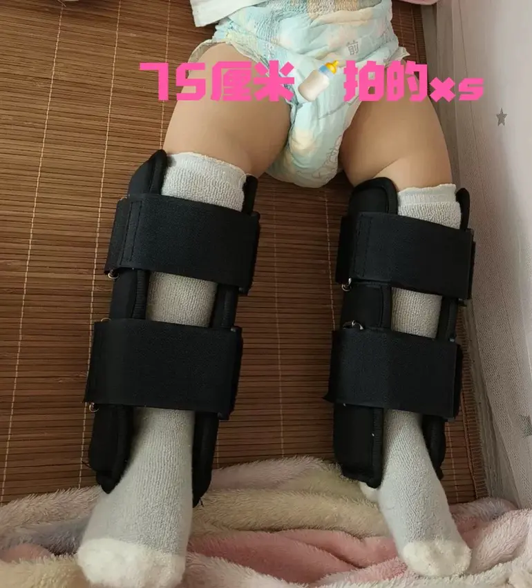 婴幼儿内八矫正内八矫正外八矫正罗圈腿矫正o型腿o型腿矫正