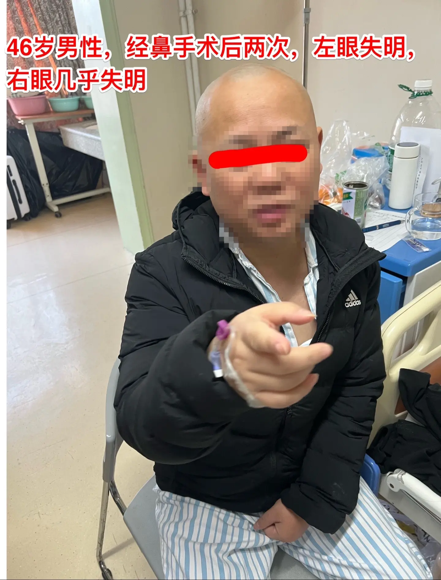46岁男性两次经鼻手术后再次开颅手术。这是昨日视频中说到的男性病人。 ...