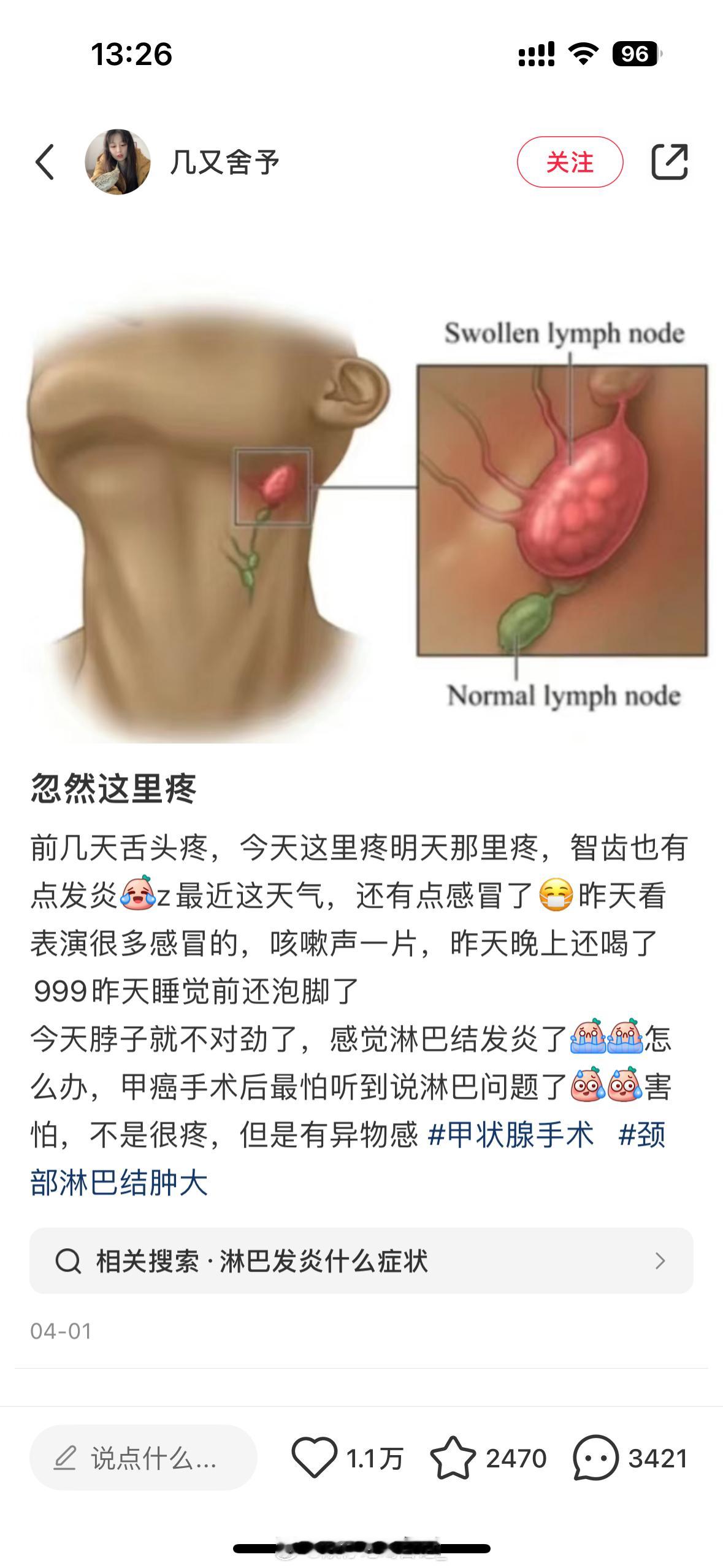 每次感冒的时候右边脸的淋巴结老是会肿起来然后滑来滑去的，很吓人[抓狂][抓狂][