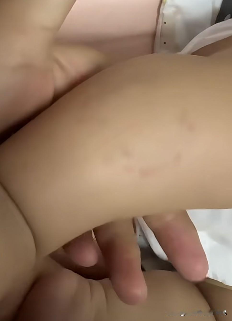 宝宝办完百日宴，发现宝宝小腿处有咬痕
      孩子哭闹一直都没觉得是孩子受伤