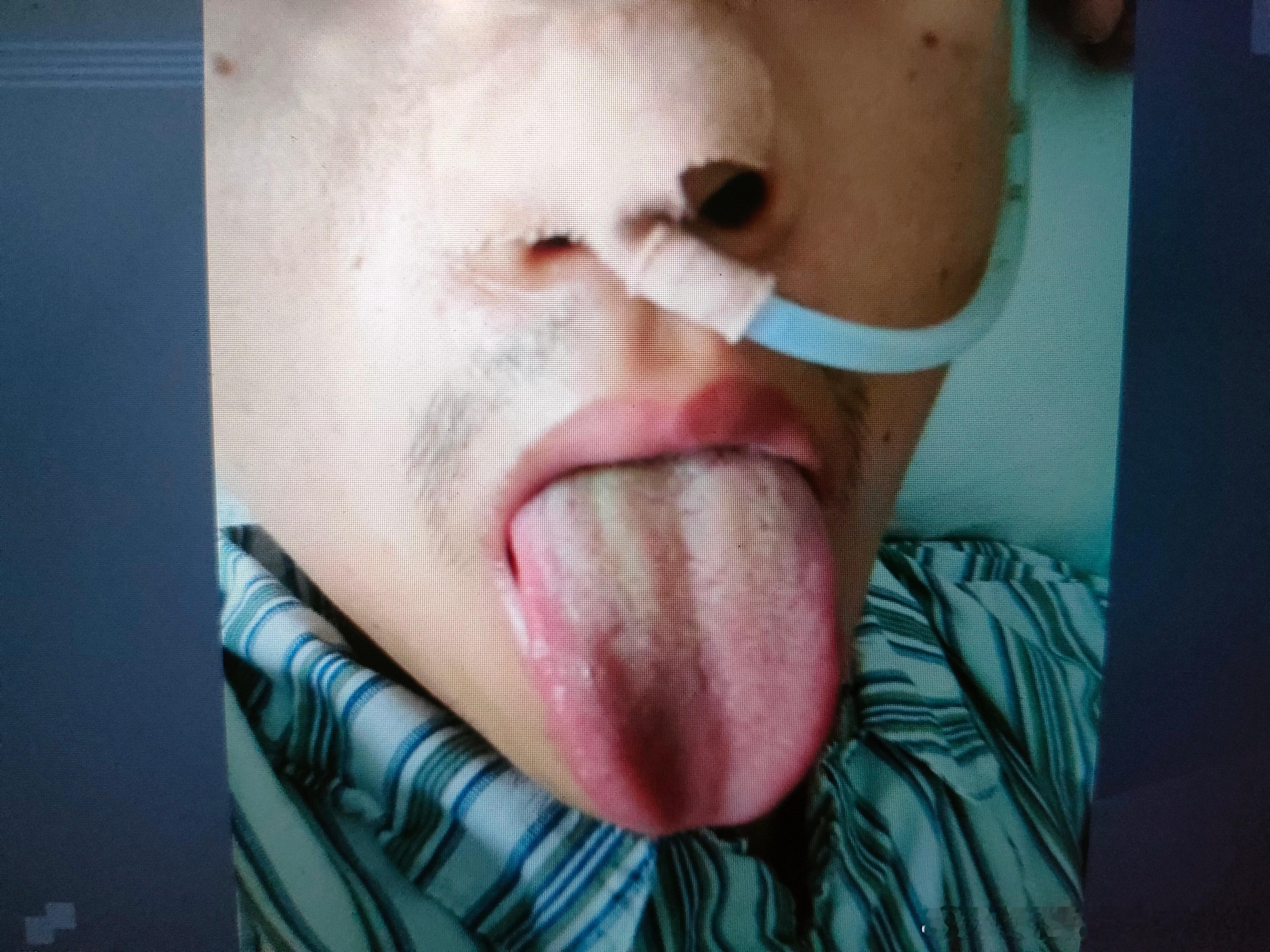 #大学生因一顿烧烤进ICU换了5次血#格林巴利综合症就是《金匮要略》“中风历节”