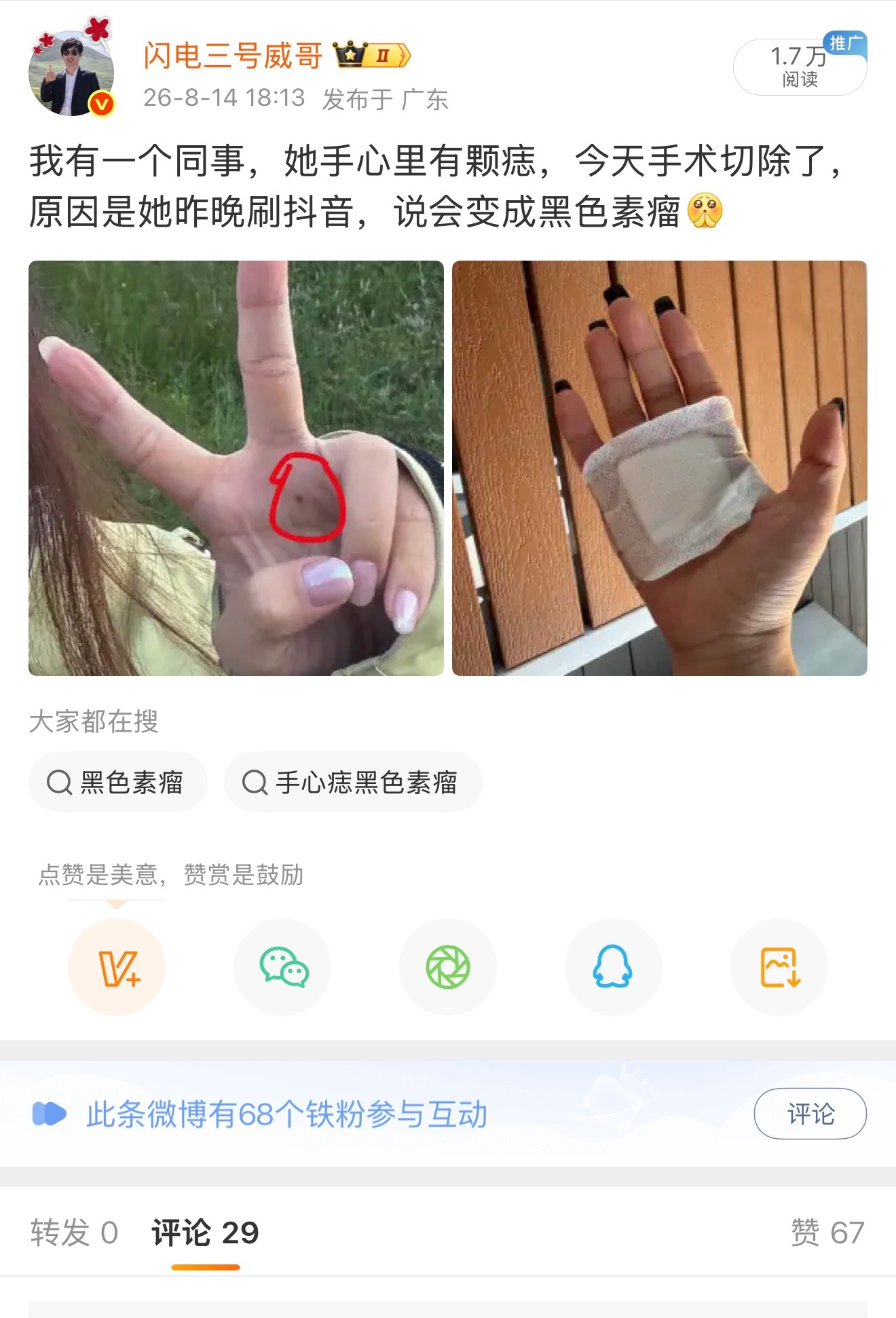 还是要注意一下，检查下你发手掌和脚掌，有没有黑痣，这玩意可能发展成为黑色素瘤，而