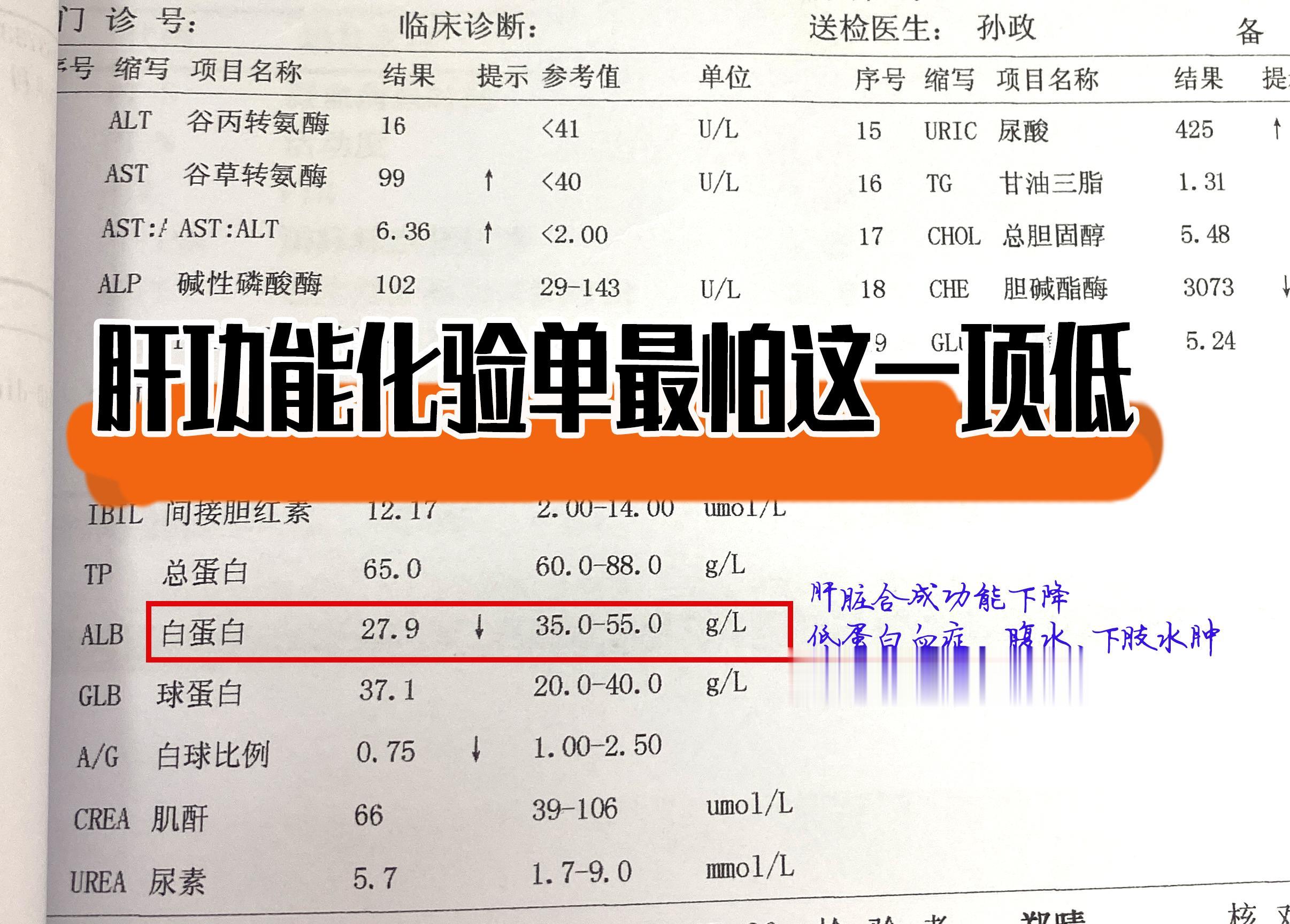 该患者20多年的饮酒史，乙肝多年未治疗。化验单上谷草升高，谷丙与谷草的...