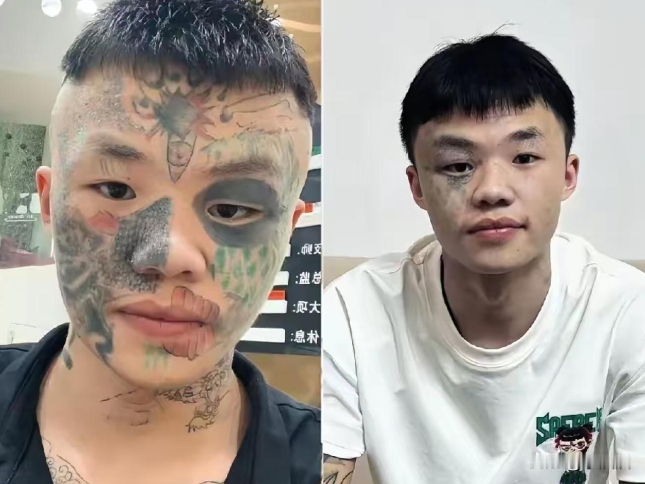 广东06年生的夏朝勇，

正用五次激光洗纹身的剧痛，

为13岁那年的天真买单。