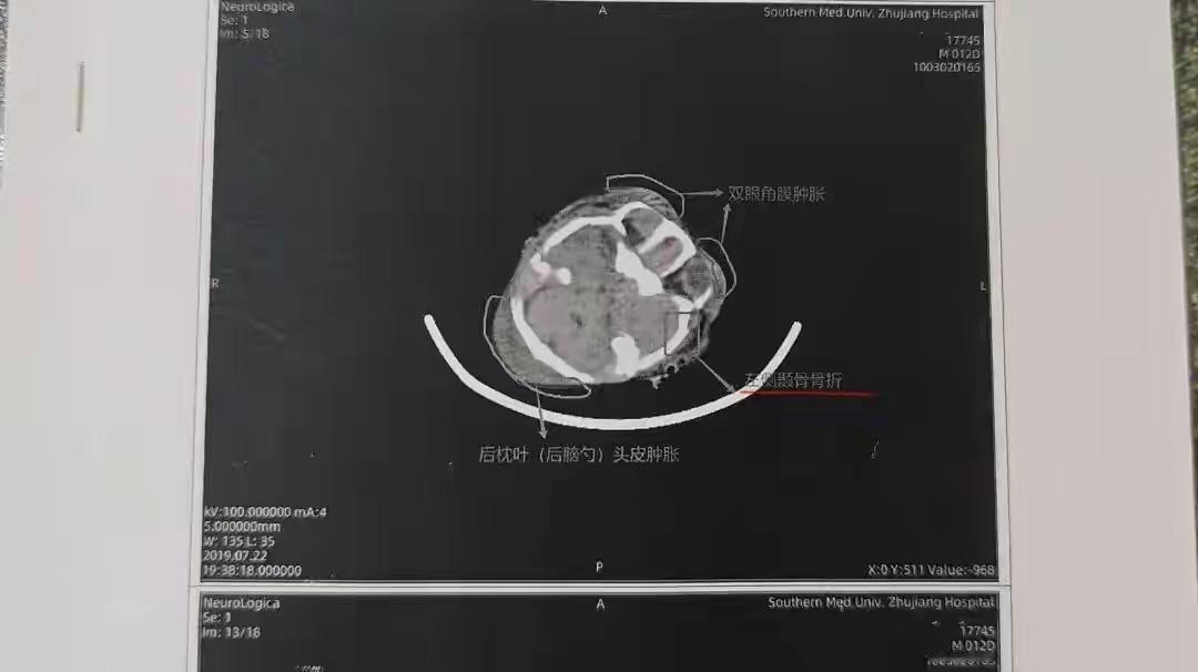 7岁男童仅18斤，被当“脑瘫”治了7年！翻出CT才发现出生时竟多处颅骨骨折！妈妈