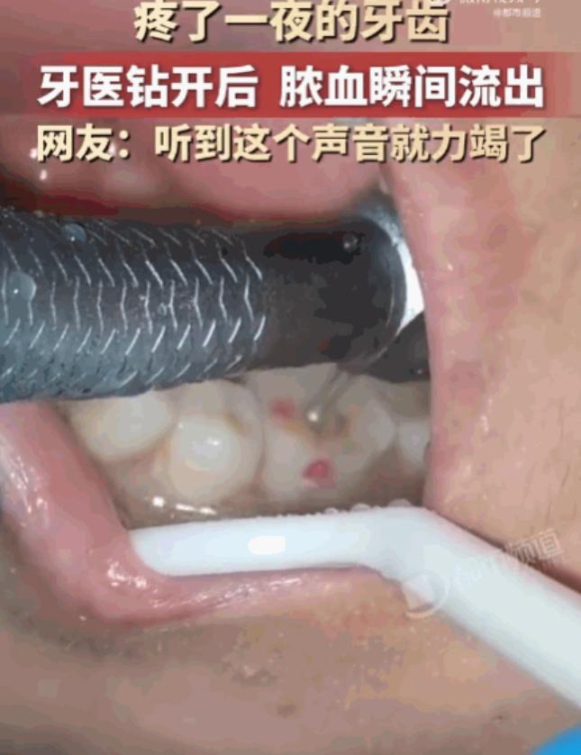 “牙疼不是病，疼起来真要命”河南，一男子深夜突发剧烈牙痛，整整一夜被折磨得死去活