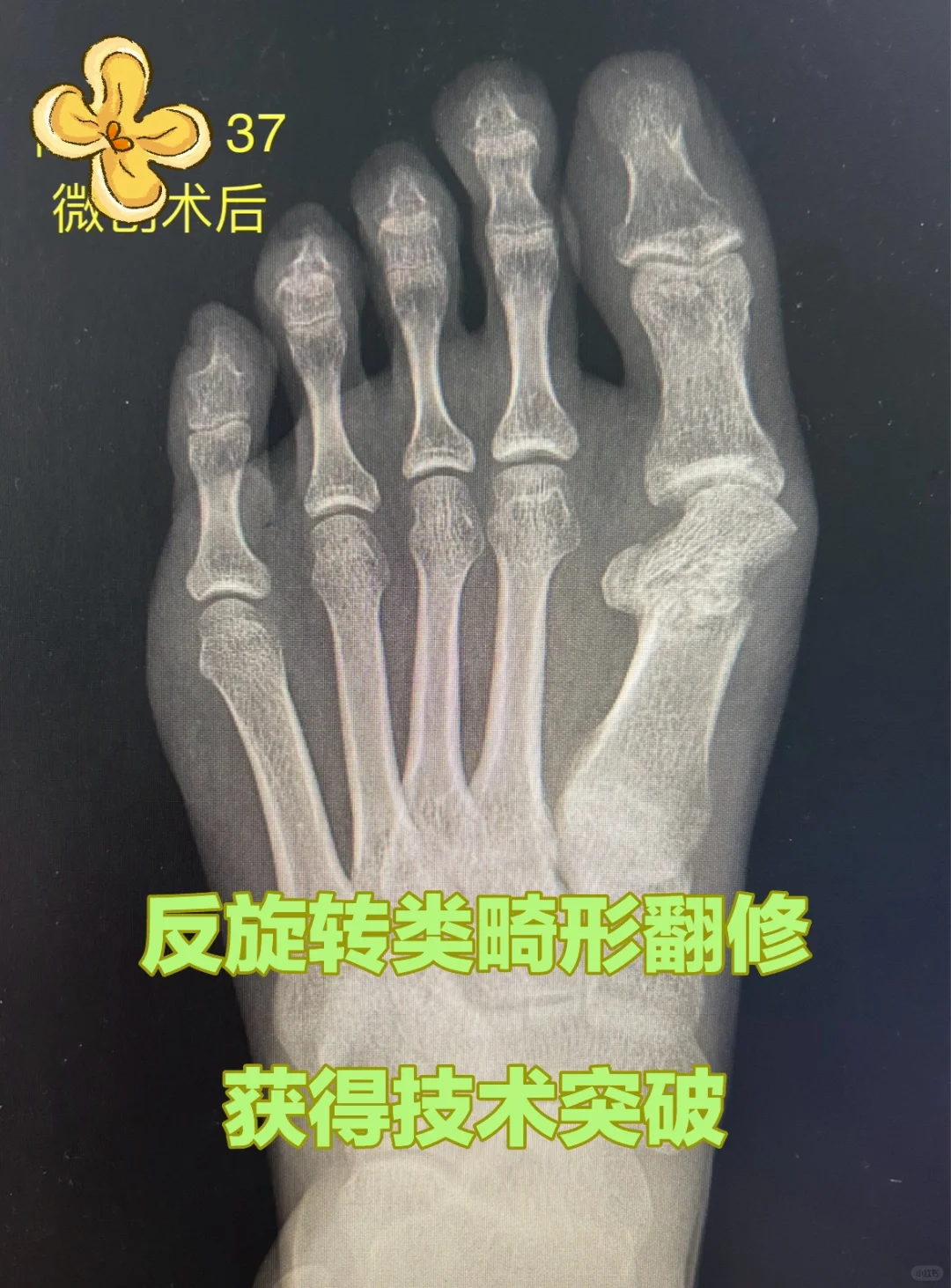 微创术后II型畸形翻修……获得研究突破