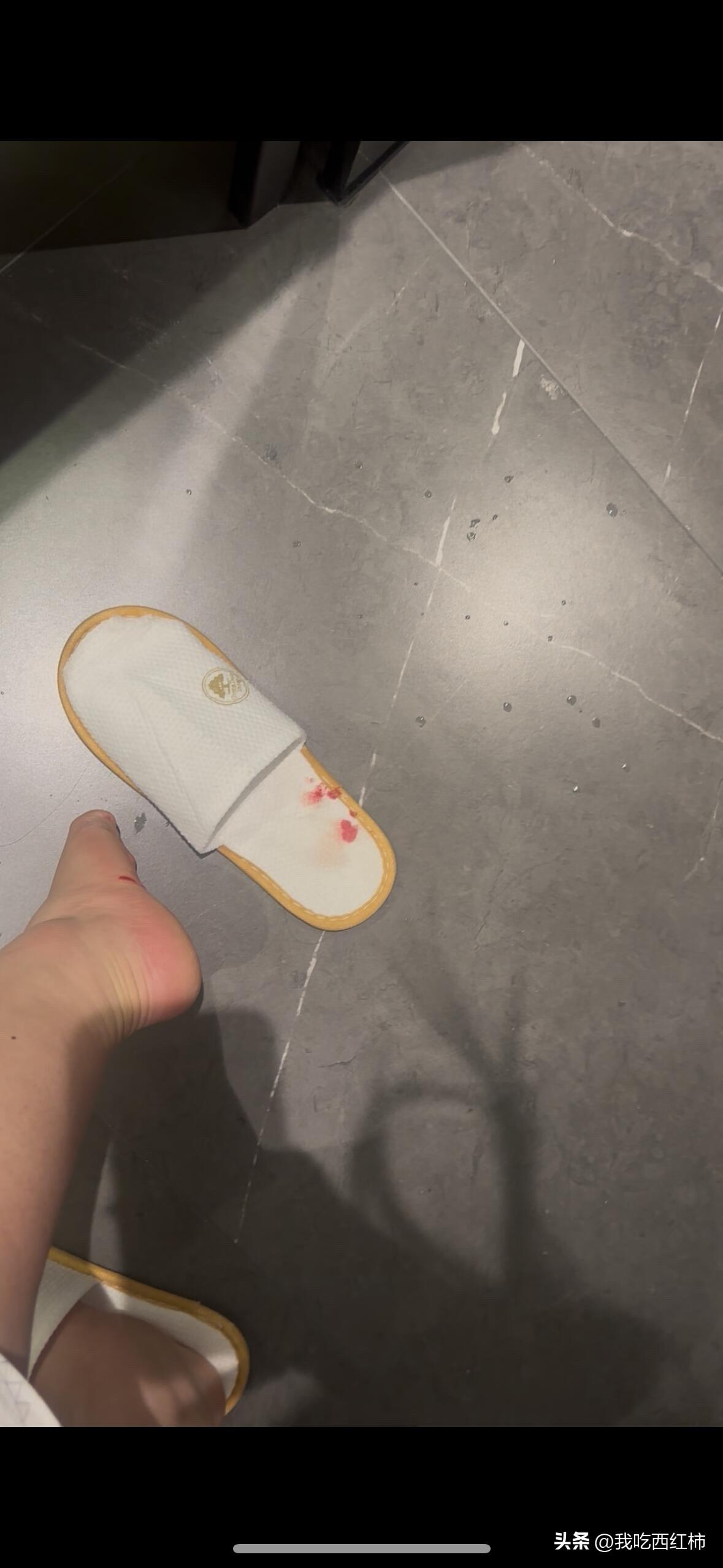 合肥省考当晚被酒店遗留玻璃扎伤
3.13晚上11点半左右，我在酒店房间内蹲下时，