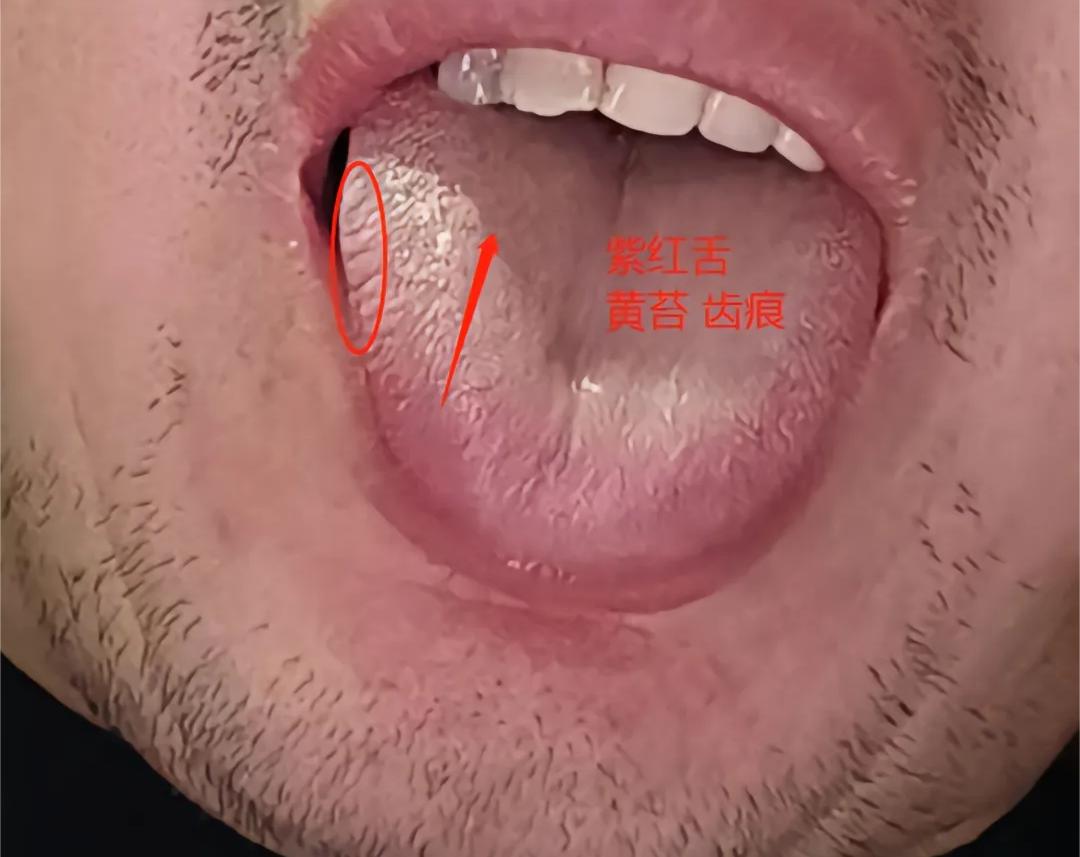40来岁的人了，欲望还这么大[黑线][尬笑]
今天出场的病友说，我完蛋了，彻底完