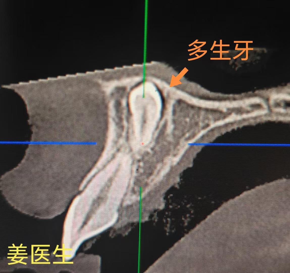 埋伏多生牙。多生牙，唇侧入路，分牙拔除。需注意保护临牙血供。