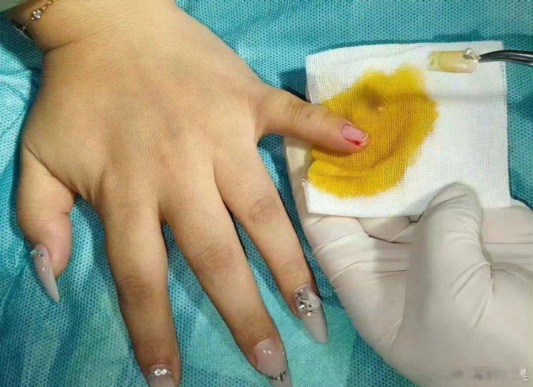 湖南一女子心跳骤停美甲阻碍抢救28岁女子突发暴发性心肌炎心跳骤停，抢救时因长款美