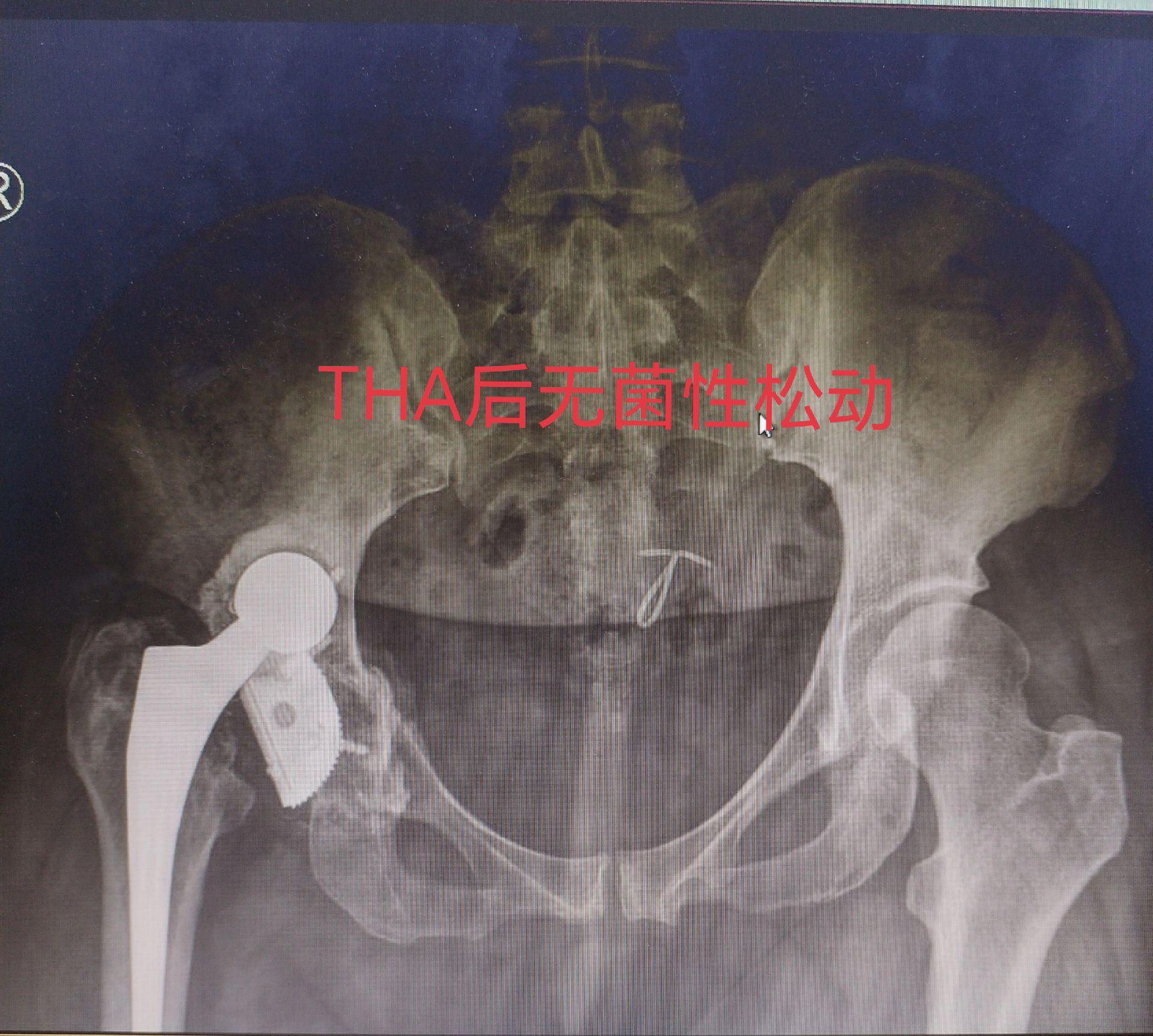 髋关节翻修术。髋关节置换术后假体磨损导致松动，一期翻修，只要重建的牢固，一样可以两天下床走路。愿每一个病人都能快速康复🌹关节置换