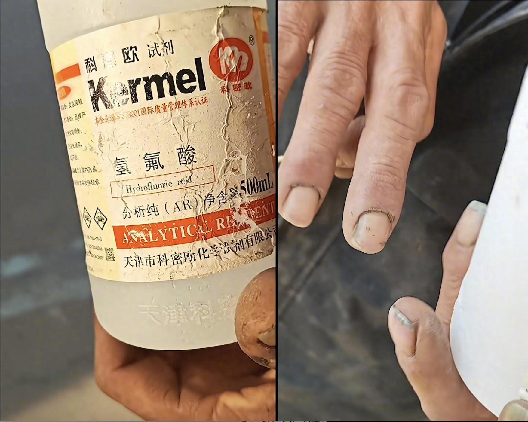 【老人捡到化骨水滴到手指就医求解药，医生回应老人捡到化骨水滴到手指，已接受治疗目