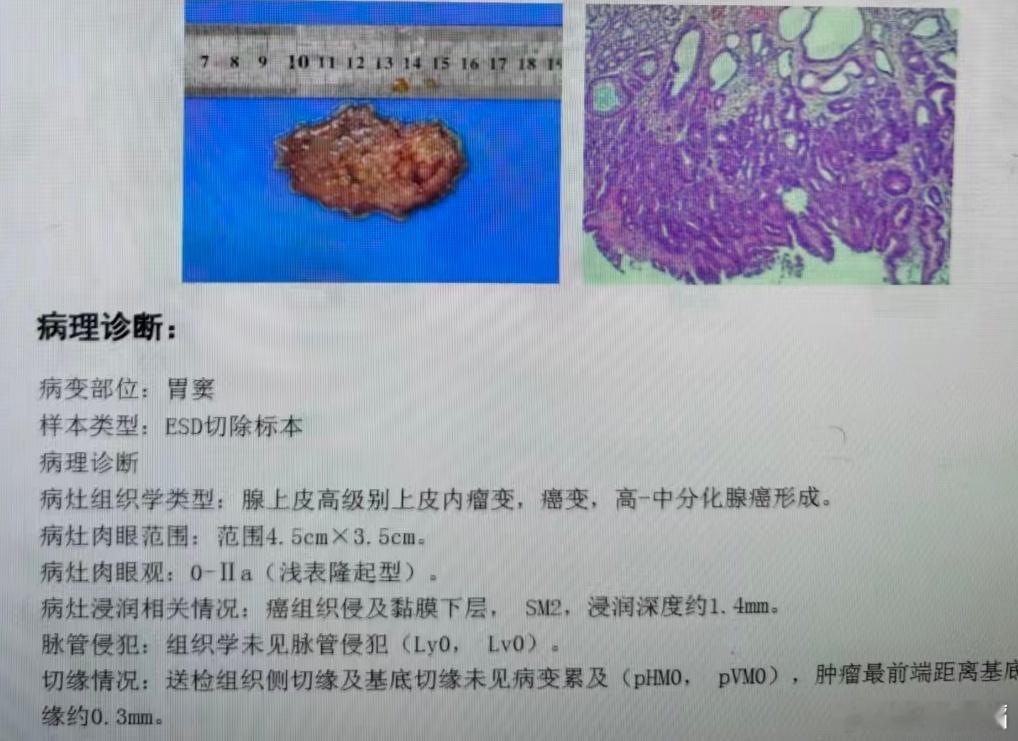 SM=submucosa 黏膜下层；浅表消化道癌浸润分层：SM1（上1/3）、S