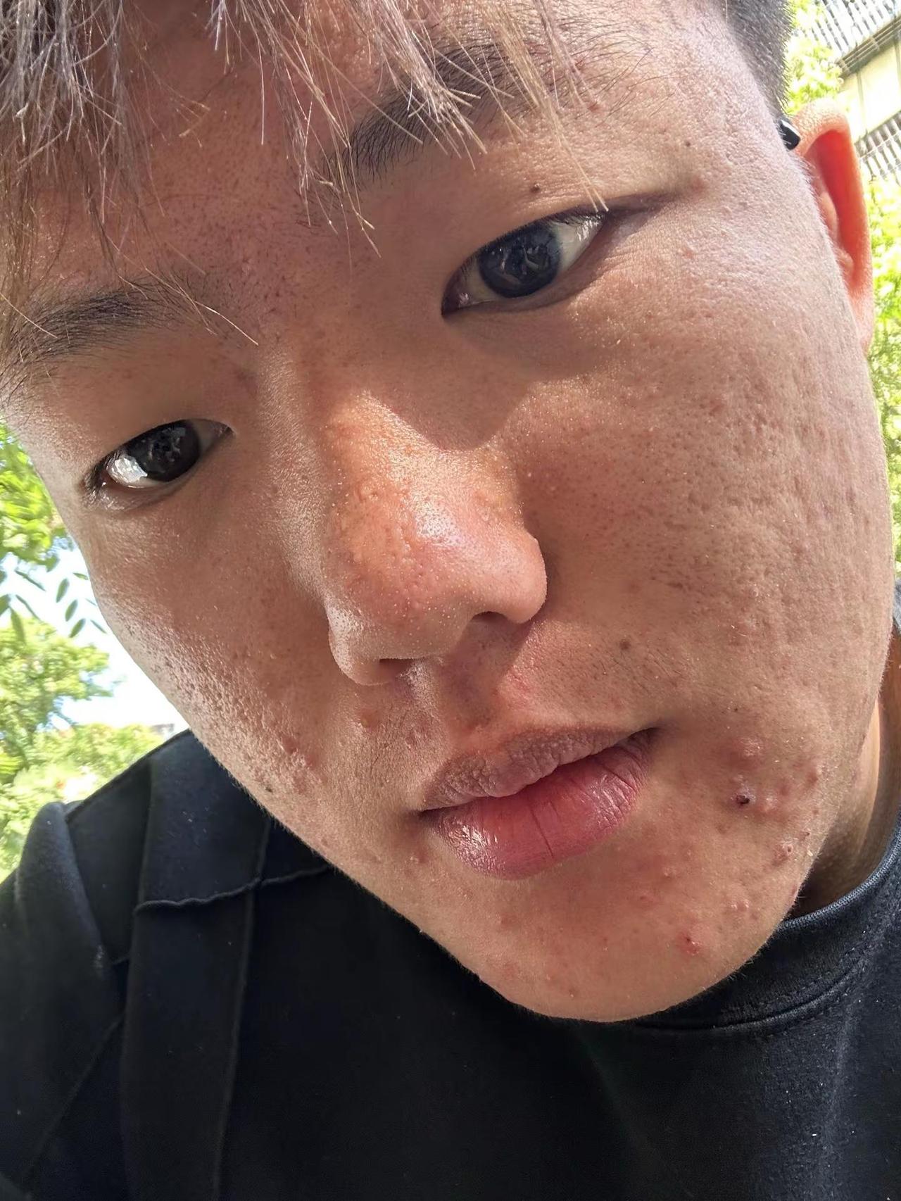 或许我脸上没有痘 你肯定还会再给我一次机会我恨你痘痘如何拯救痘痘肌