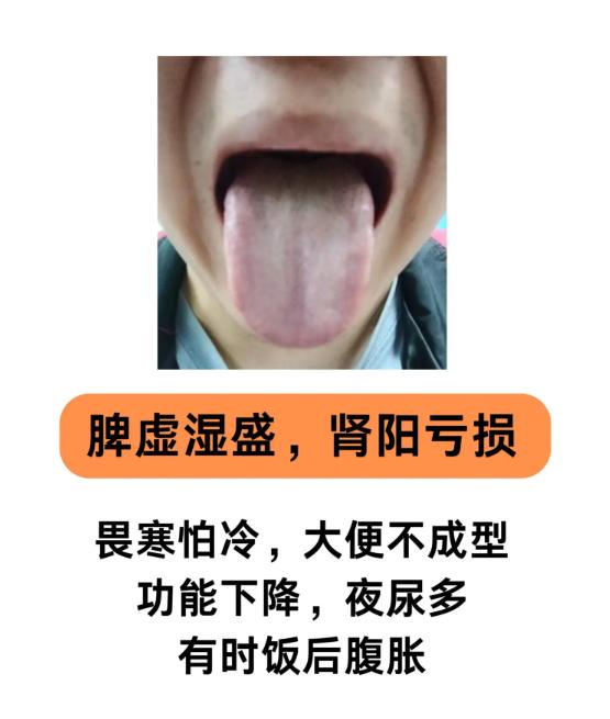 阳虚寒湿重，3 种舌象一看便知