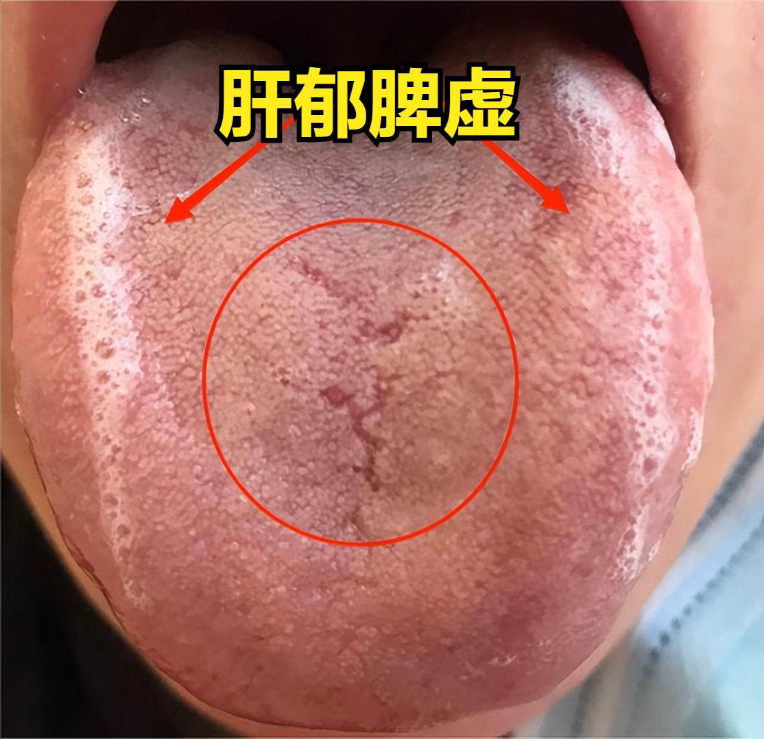 肝郁的四种舌苔表现，快看看你有没有中招！

 
1、肝郁克脾
舌象：舌两边鼓胀，