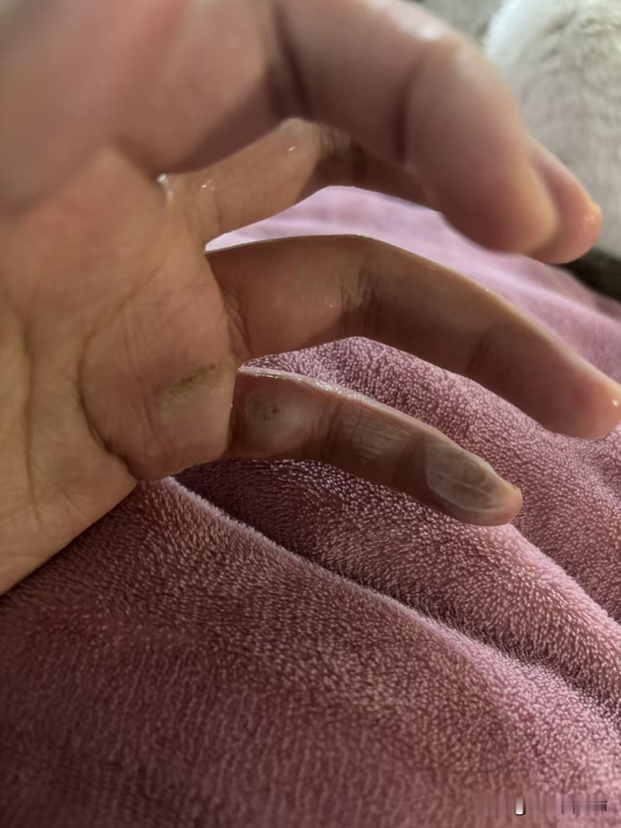 各位兄弟姐妹你们好，刚才我放手持烟花受伤了。已经用冷水冲了很久了，现在的情况如图