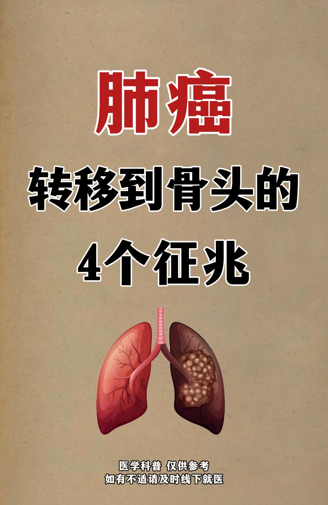 肺癌转移到骨头的4个征兆。
