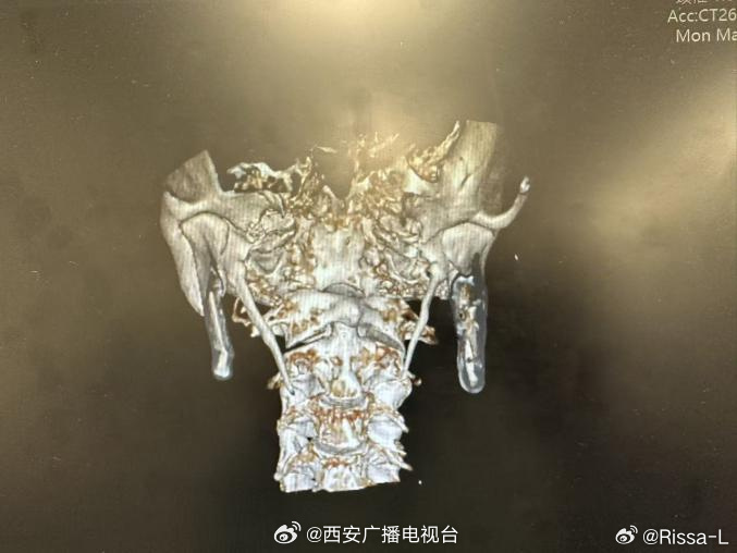 肝衰竭姐姐放弃治疗救弟痛哭不想死河南姐弟双双确诊肝衰竭，高额医药费压垮家庭，父亲