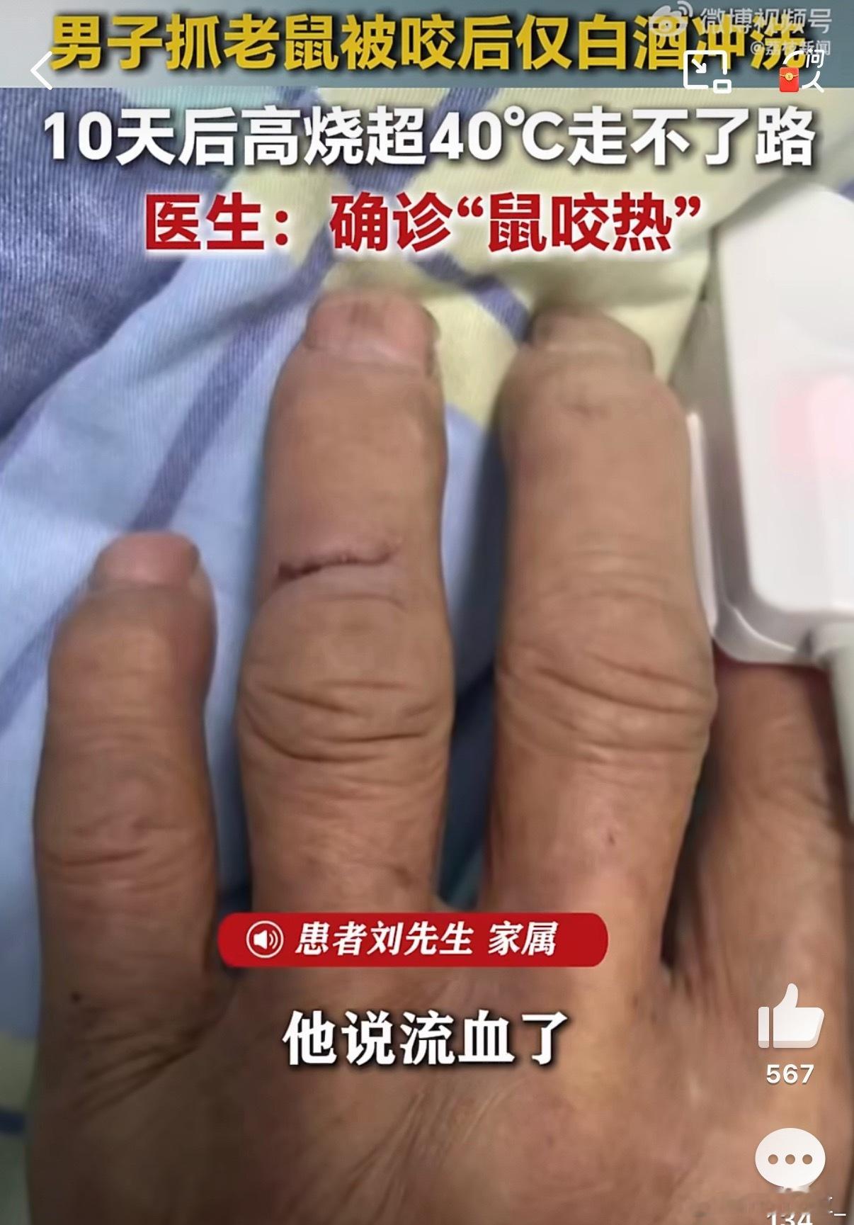 每日热议被老鼠咬10天后确诊鼠咬热野生老鼠和鸽子就是最毒的，被老鼠咬了居然敢硬扛