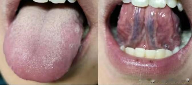 舌下青筋紫粗发黑，如果医生再让你活血化瘀，劝你抓紧换下一位！

患者主诉：晚上入